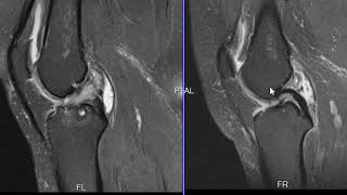 Mucoid degeneration of the ACL [upl. by Ees]