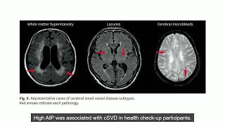 The Atherogenic Index of Plasma is Associated With Cerebral Small Vessel Disease [upl. by Akinehs368]