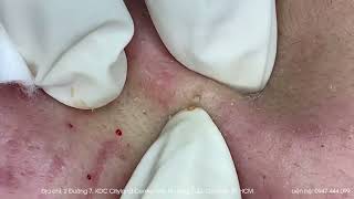 Big Cystic Acne Blackheads Extraction Blackheads amp Milia Whiteheads Removal Pimple Popping [upl. by Rihat]