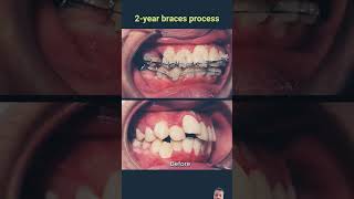 Braces evolution  2 years braces orthodontistdentist shorts [upl. by Ramirol]