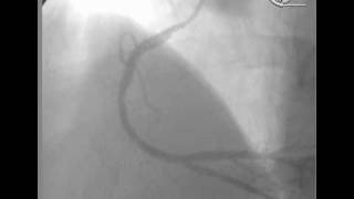 angioplastia en Infarto Agudo [upl. by Serg832]