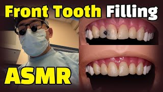 How to fix cavities between front teeth  Dental ASMR Composite Resin Filling Procedure Explained [upl. by Bevon]