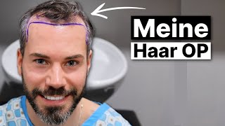 Sebastian 30 teilt seine Erfahrung mit der Haartransplantation [upl. by Suzann433]