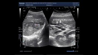 Distended Gallbladder with Cholelithiasis associated with Choledocholithiasis and Hepatic Mass [upl. by Bosch90]