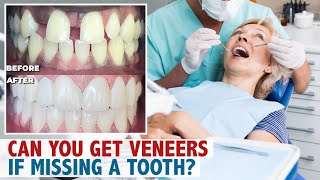 Can You Get Veneers If Missing A Tooth [upl. by Ananna]