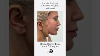 5 luni după operația de Lifting Facial la Clinica Doctor Levy din București România [upl. by Nawud]