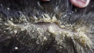 Dandruff scratching removal on head using black combing390 [upl. by Hewes185]