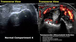 Wrist Hand amp Finger Ultrasound Normal Vs Abnormal Images  Tenosynovitis Rheumatoid Arthritis USG [upl. by Nyladam199]