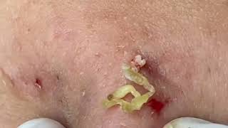 Blackheads amp Whiteheads Removal On Girls Chin 2024 Acne Treatment With Nhat Bang Channel 002 [upl. by Gausman]