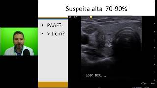 Ultrassonografia da glândula tireoide [upl. by Dorolisa339]