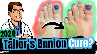 Bunionette Tailors Bunion Surgery Corrector Splints amp Treatment [upl. by Karli831]