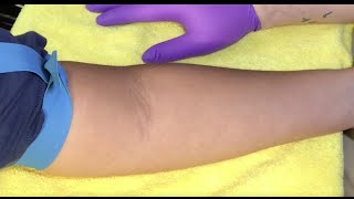 Tips For Locating Difficult Veins [upl. by Annadiana]