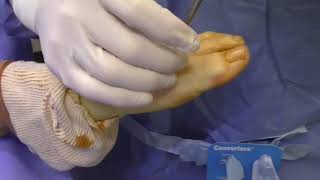 Bunion Screw Removal [upl. by Havard]