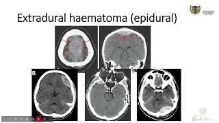 INDICACIONES QUIRÚRGICAS EN TRAUMA CRANEOENCEFÁLICO [upl. by Eimaj]