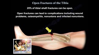 Open Fractures Of The Tibia  Everything You Need To Know  Dr Nabil Ebraheim [upl. by Adyahs]