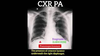 Pneumoperitoneum  CXR PA  Diagnosis   Radiology [upl. by Sanalda]