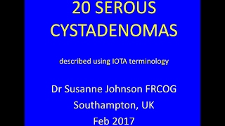 serous cystadenomas YouTube Feb 2017 [upl. by French450]