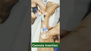 Cannula insertion techniqueHow to give cannula cannula kese lagate hai shorts ytshorts youtube [upl. by Donelson451]