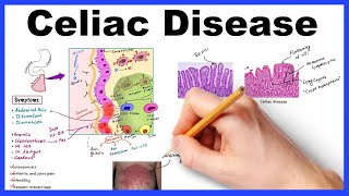 Celiac disease  Pathophysiology Symptoms Histology Diagnosis amp Management [upl. by Zumstein]