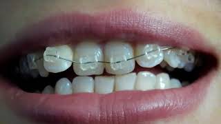 aparat ortodontyczny ESTETYCZNY szafirowy shappire braces [upl. by Latton388]