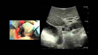 BK Medical Intraoperative Ultrasound Imaging of the Liver [upl. by Allred981]