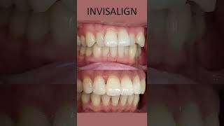 Invisalign  Before And After  Crooked Teeth  London UK [upl. by Areik]