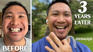 3 YEAR TEETH JOURNEY UPDATE  MONTH 38 UPDATE  Invisalign Journal [upl. by Beth810]