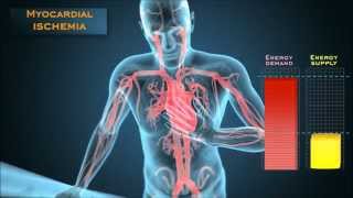 Understanding the energetic mechanisms that cause angina pectoris [upl. by Yzdnil663]