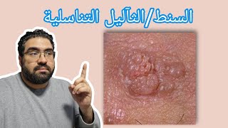 عيادة الجلدية  حلقة ٨  السنطالثآليل التناسليةgenital warts [upl. by Yrennalf]