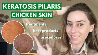 Keratosis Pilaris How to treat dry bumpy skin aka chicken skin  Dr Shereene Idriss [upl. by Llertnek]