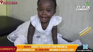 As I Grow NGO and EIB network support Adepa to recover from phocomelia deformity [upl. by Alle]