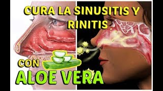 CÓMO CURAR LA SINUSITIS Y RINITIS ALÉRGICA CON ALOE VERA  LifeStyle [upl. by Arihk712]