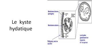 PNEUMOLOGIE KYSTE HYDATIQUE 2016 [upl. by Seldan]