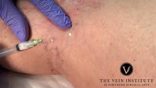 More Sclerotherapy Treatment for Spider Veins [upl. by Ralleigh]