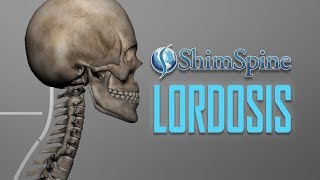 Lordosis [upl. by Allebara49]