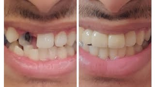 Multidisciplinary treatment with braces endodontics and prosthodontics [upl. by Aicert229]