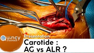 ALR ou AG pour la chirurgie carotidienne [upl. by Tjon]