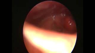 Fungal Laryngitis 4 weeks Post treatment [upl. by Sset484]