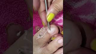 cleaning thick curved toenail videos pedicure satisfying subscribe [upl. by Pastelki]