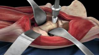 Direct Anterior Approach Hip Replacement [upl. by Rigby147]