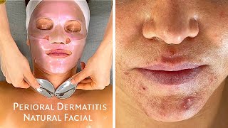 ASMR Rosacea amp Inflamed Perioral Dermatitis Acne Facial Jadeywadey180 [upl. by Edelson]