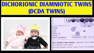 DCDA TWIN PREGNANCY IN HINDI DCDA TWINS MEANING DICHORIONIC DIAMNIOTIC TWINS  2023 twins [upl. by Mochun]