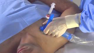 Part 2 Axotrack Tips  Subclavian Vein Central Venous Access [upl. by Led]