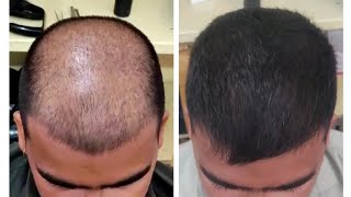 Amazing Hair Regrowth 😲😲। Dr Danish Chauhan। HairFall hairloss baldness PRP GFC transplant [upl. by Ayal]