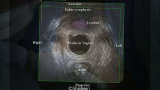 OnabotulinumtoxinA Injection of the Levator Ani Muscles under Ultrasound Guidance [upl. by Jeu]