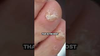 Trimming of SUPER THICK BIG TOENAILS [upl. by Sabas]