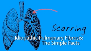 Idiopathic Pulmonary Fibrosis The Simple Facts [upl. by Mutat]