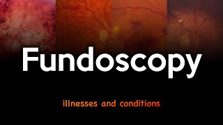 Fundoscopy Illnesses and Conditions [upl. by Ttocserp]