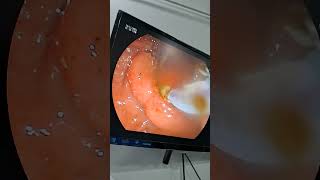 Endoscopy Ercp endoscopicspinesurgery hospital ercpnationalproject videogames foryou draw [upl. by Muslim]