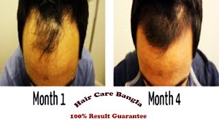 Homeopathic Medicine For Alopecia and Baldness  Hair Care Bangla [upl. by Sikorski]